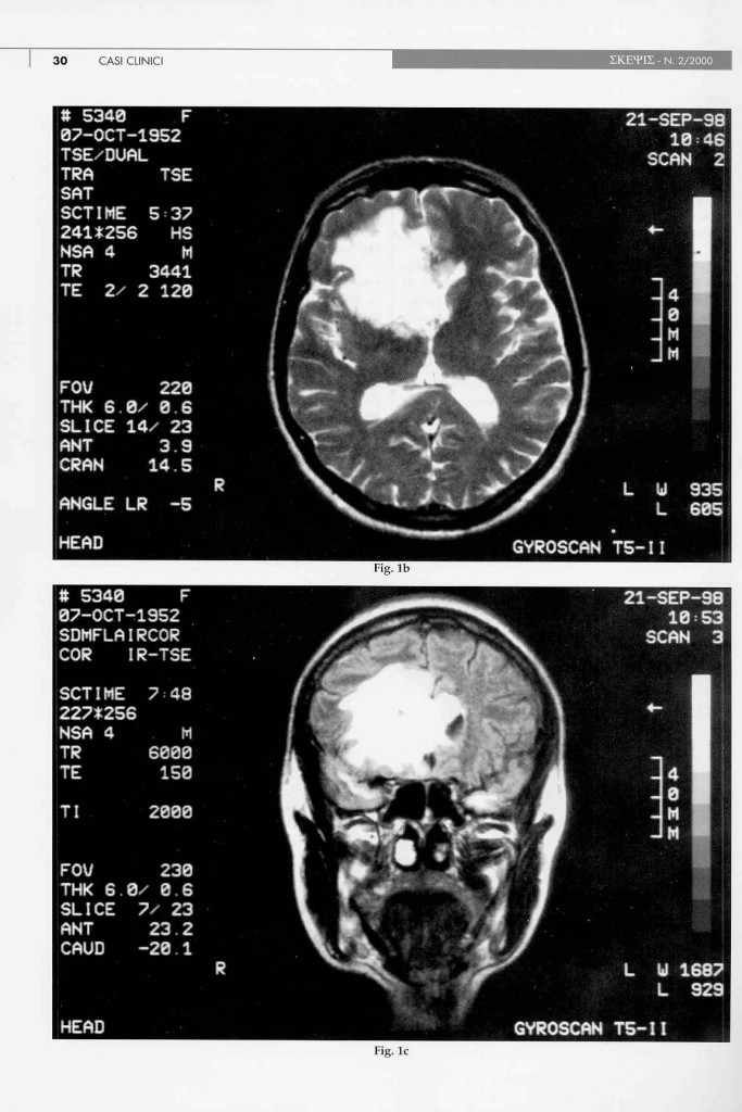 eteroplasia-cerebrale-n.a.s.-page-2.jpg