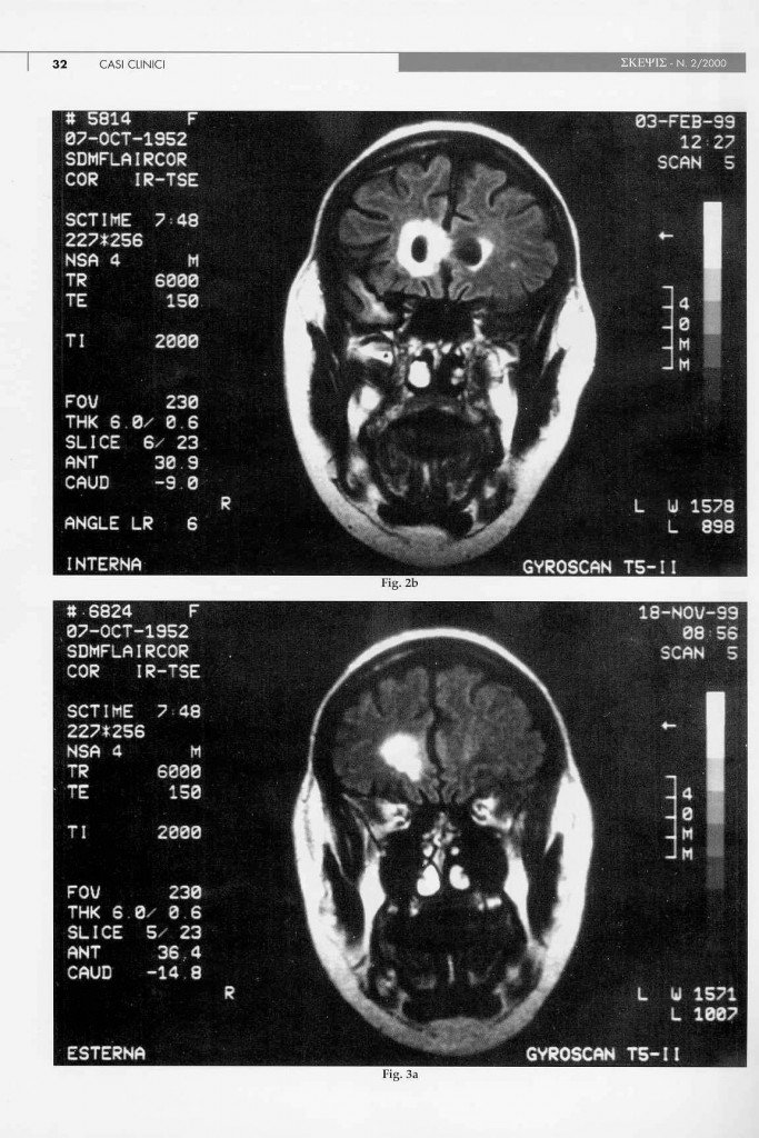eteroplasia-cerebrale-n.a.s.-page-4.jpg