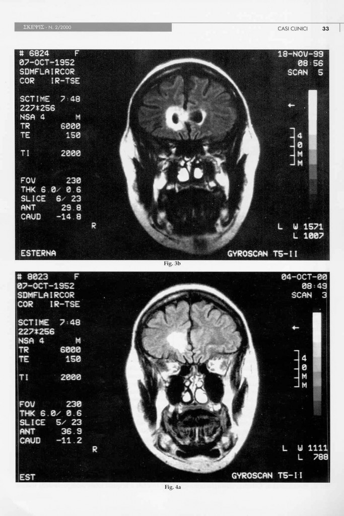 eteroplasia-cerebrale-n.a.s.-page-5.jpg