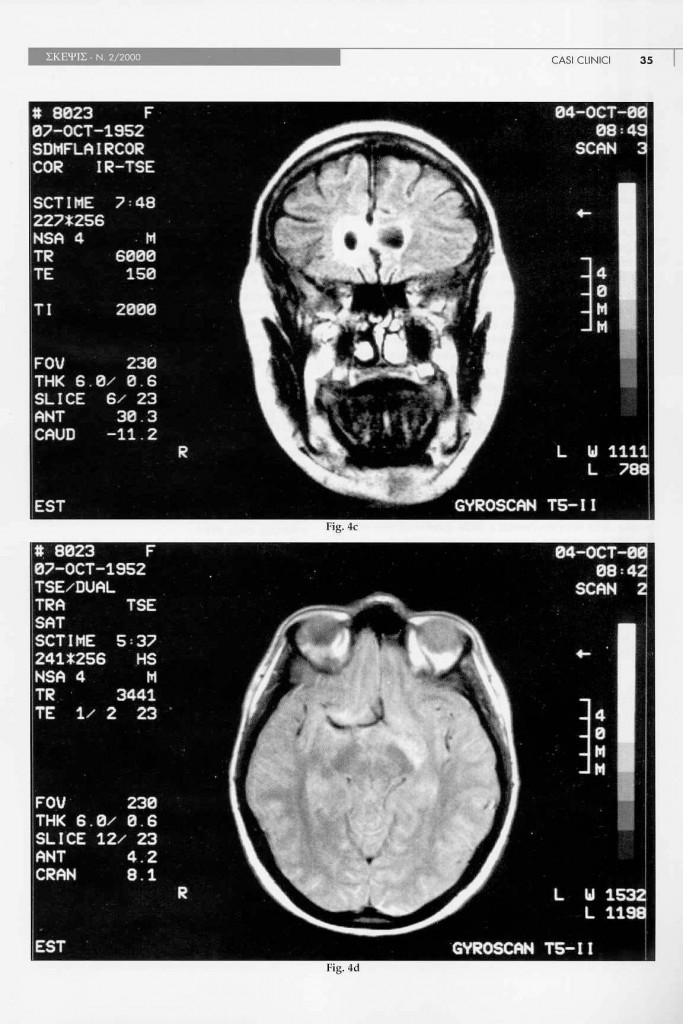 eteroplasia-cerebrale-n.a.s.-page-7.jpg