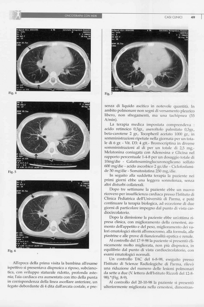 sarcoma-osteogenico-page-2.jpg